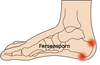 Fersensporn Plantarfasziitis Beschwerden, orthopädische Einlagen online / einlage.de