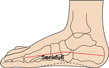 Knick-Senkfuß Beschwerden, orthopädische Einlagen online / einlage.de