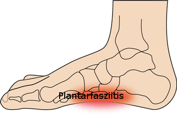 Plantarfasziitis Beschwerden, orthopädische Einlagen online / einlage.de